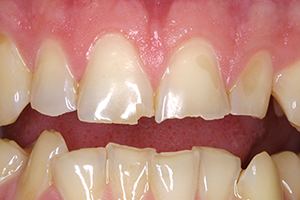 This is how erosion shows on your teeth